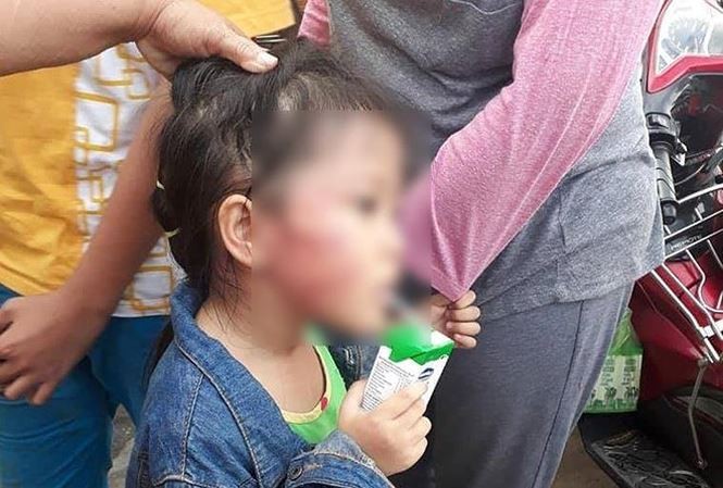 Bé Chi (5 tuổi) với thương tích trên mặt nghi bị cô giáo bạo hành. Ảnh: Người nhà cung cấp 