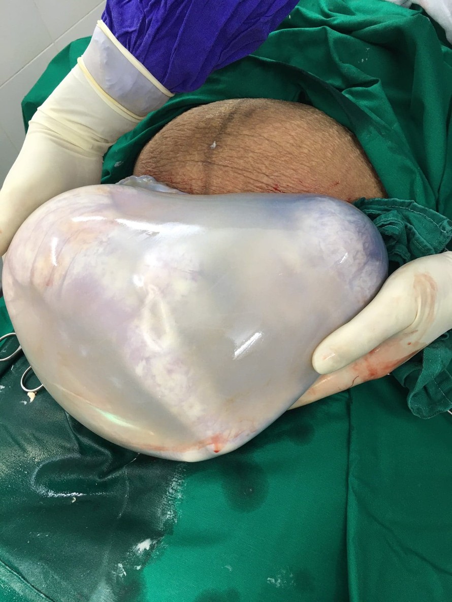 Kỳ diệu hai bé song sinh nằm gọn trong bọc ối hình trái tim
