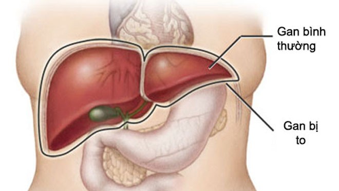 Những dấu hiệu chứng tỏ bạn bị tổn thương gan