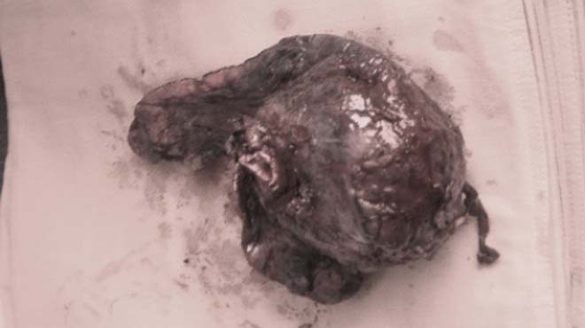 Khối u "khủng" được bóc từ phổi của bệnh nhân M.