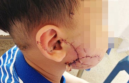 Bé 4 tuổi bị chó béc-giê cắn nát mặt
