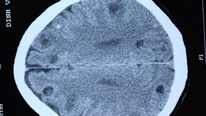 Một lát chụp CT não của bệnh nhân phát hiện nhiều sán đang làm tổ trong não. 