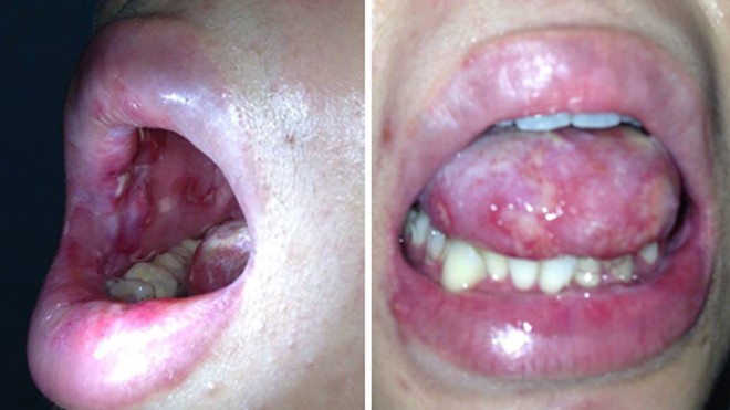 Bệnh nhân bị lở loét nhiều ở vùng môi, lưỡi và niêm mạc má (ảnh do BS cung cấp)