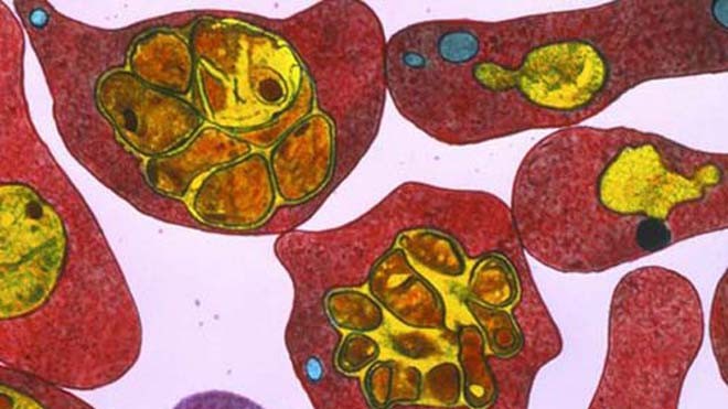 Hồng cầu nhiễm sốt rét Ảnh: BBC