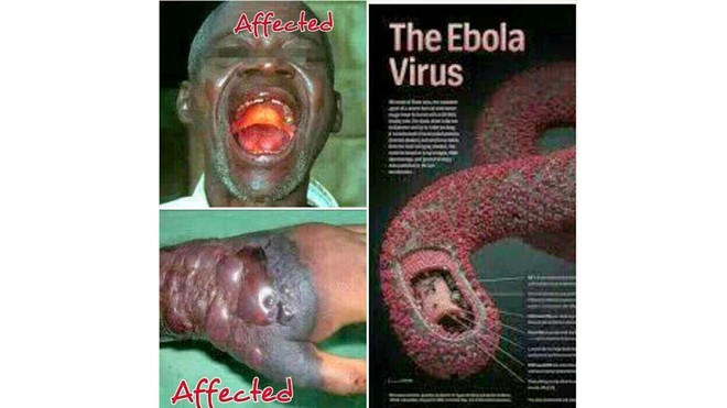 Cận cảnh người bị bệnh do vi rút Ebola. 