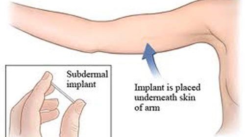 Que cấy tránh thai được cấy vào dưới da phía mặt trong cánh tay không thuận.