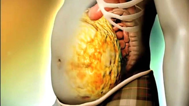 Béo phì, đặc biệt là béo bụng gây ra nhiều bệnh lý nguy hiểm.