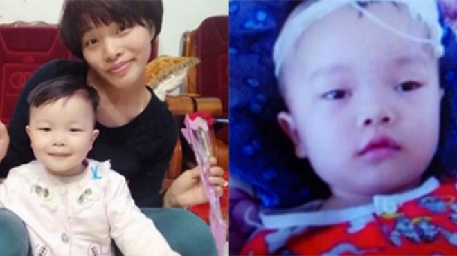 Bé gái trước và sau khi bị bệnh. Ảnh: Shanghaiist
