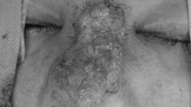 Hình chiếc mũi của chị C. bị silicon lỏng tàn phá 