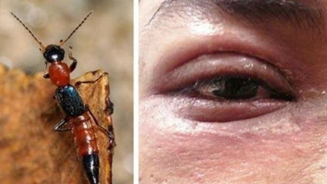 Con người không phải là mục tiêu tấn công của kiến ba khoang song nếu để độc tố dưới bụng nó dính vào mắt thì có thể gây bỏng mắt hoặc bị mù tạm thời. Ảnh: Thiên Lam 
