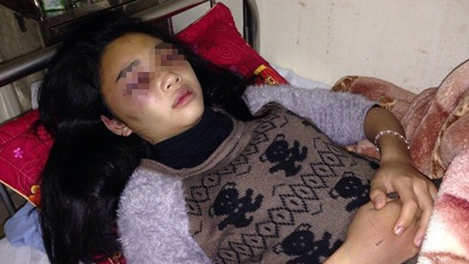 Nữ sinh Trần Thị Anh Thơ với những vết bầm trên mặt và tay. 