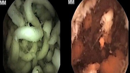 Hình ảnh mỳ ăn liền (trái) vẫn "nguyên hình"sau nhiều giờ nằm trong dạ dày.