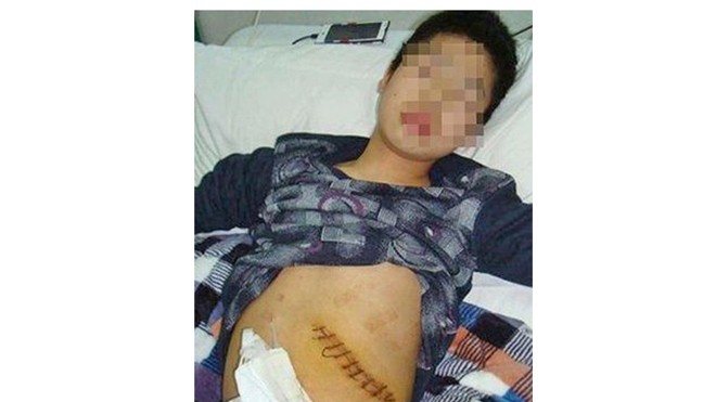 Dong Kung được các bác sĩ mổ cấp cứu để cắt bỏ phần lá lách bị vỡ. Ảnh: CEN