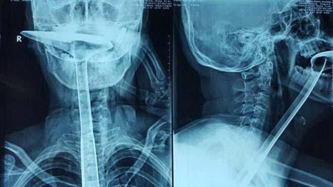 Hình ảnh X-quang cho thấy bàn xẻng dài trong thực quản bệnh nhân. Ảnh: Imaginechina/Rex Shutterstock.