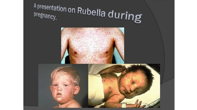 Rubella - Căn bệnh không thể xem nhẹ