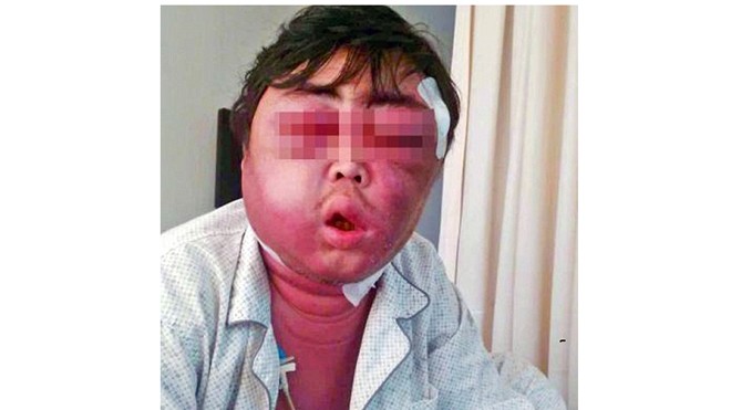 Nam bệnh nhân với gương mặt sưng phù, đỏ tấy vì vết muỗi đốt. Ảnh: People’s Daily