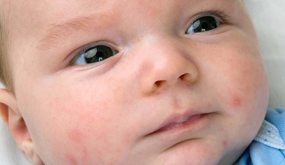 Trẻ sơ sinh có làn da nhạy cảm nên rất dễ bị phát ban, nổi mụn. Ảnh: Babycenter.