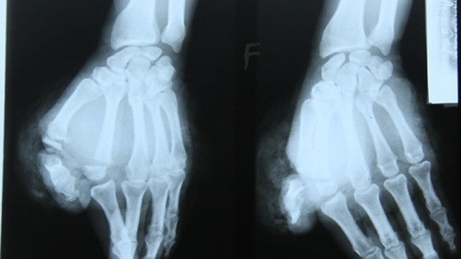 Phim X-quang bàn tay bệnh nhân Thành lúc chưa được phẫu thuật. Ảnh: Hải Bình.
