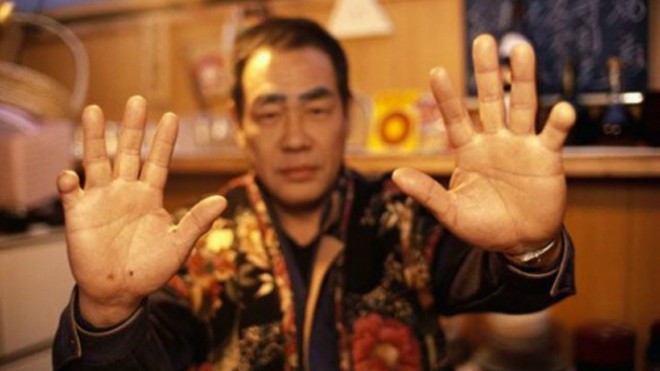 Bàn tay cụt ngón út của một yakuza. Ảnh: TWPhoto