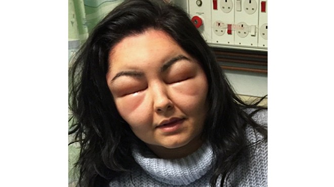 Dinya Rasool chụp tại bệnh viện sau khi bị dị ứng với thuốc nhuộm tóc khiến cô không thể mở được mắt