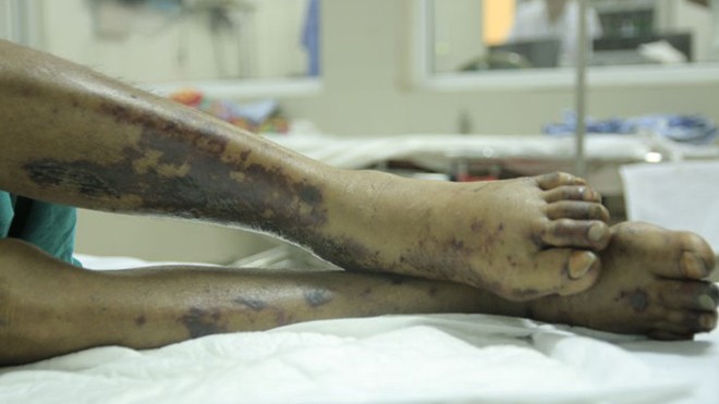 Tổn thương hoại tử trên da điển hình của bệnh nhân nhiễm trùng huyết do liên cầu lợn. Ảnh minh họa: H.Hải