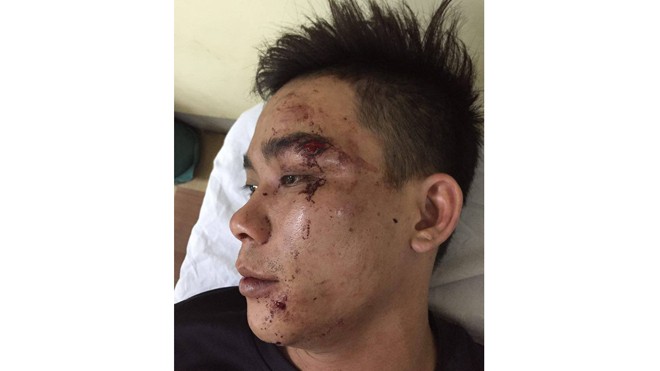 Bị côn đồ đánh đập dã man, anh Đặng Quốc Hương phải nhập viện.