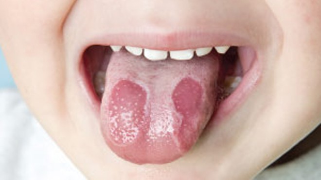 Viêm lưỡi bản đồ là dạng viêm lành tính của lưỡi (Ảnh minh họa) 