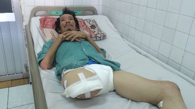 Bệnh nhân Dương Tấn Huê hiện đang điều trị tại khoa Bỏng - Tạo hình Thẩm mỹ Bệnh viện Trưng Vương. Ảnh: Lê Phương.