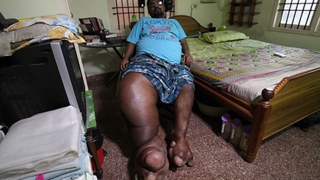Mắc chứng bệnh lạ khiến đôi chân Arun căng phồng như bong bóng, trong đó chân phải có khối lượng lên đến 100kg