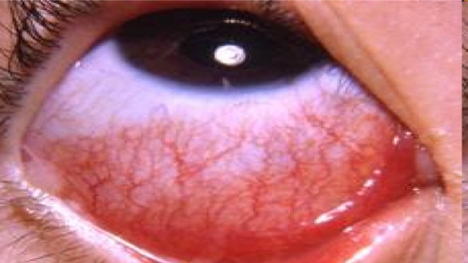 Viêm mắt cấp tính do vi khuẩn.