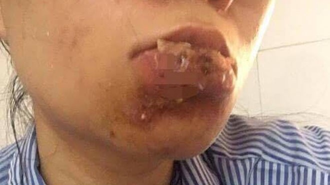 Thiếu nữ 23 tuổi bị hoại tử phải cắt bỏ môi vì tiêm chất làm đầy tại một cơ sở spa