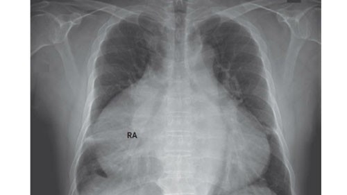 Ảnh chụp X quang cho thấy trái tim chiếm 82% lồng ngực bệnh nhân. Ảnh: The New England Journal of Medicine.