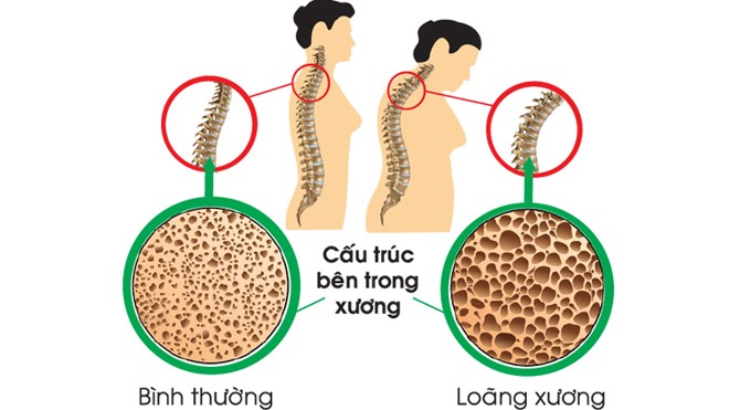 So sánh cấu trúc của xương bình thường (trái) và xương loãng (phải). Ảnh: benhcoxuongkhop.