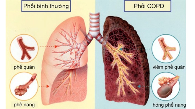 Tránh xa 6 'thủ phạm' gây nguy cơ ung thư phổi