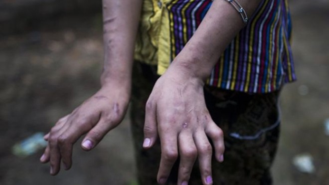Đôi tay bị biến dạng do tra tấn của một trong hai thiếu nữ Myanmar. Ảnh: AFP.