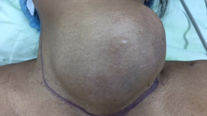 Hình ảnh khối u trên cổ bệnh nhân Y.B trước lúc phẫu thuật. Ảnh:Bệnh viện cung cấp 