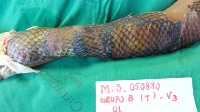 Da cá rô phi đang được các bệnh viện ở Brazil sử dụng như một phương pháp hữu hiệu để chữa bỏng. Ảnh: Ijf Burns Unit/Caters News Agency