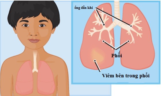 Viêm phổi ở trẻ em nếu không được điều trị kịp thời dễ dẫn đến suy hô hấp và tử vong.