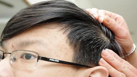 Nhìn vị trí tóc bạc sớm đoán nhiều bệnh nan y