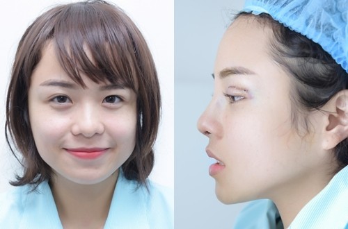 Thái Trinh trước và sau phẫu thuật thẩm mỹ (phải).