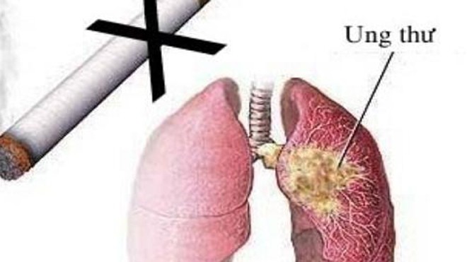 8 bệnh ung thư do hút thuốc lá