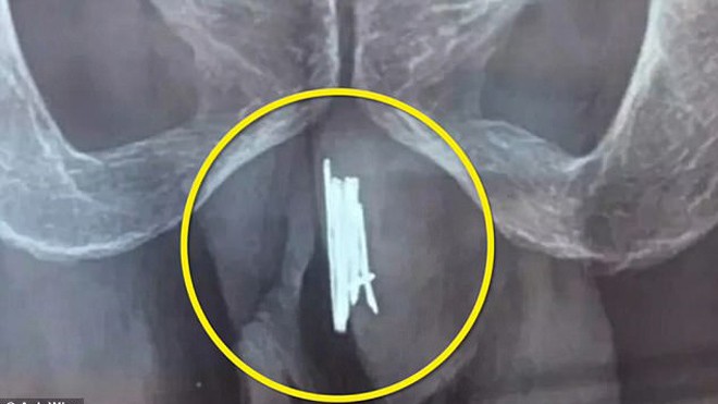 Phim chụp X-quang của bệnh nhân cho thấy đống kim khâu trong vùng kín. Ảnh: AsiaWire.