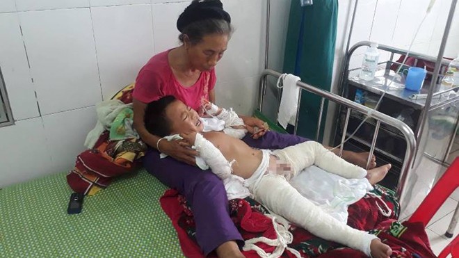 Bé Lô Văn An đang chữa trị bỏng tại bệnh viện Sản Nhi Nghệ An