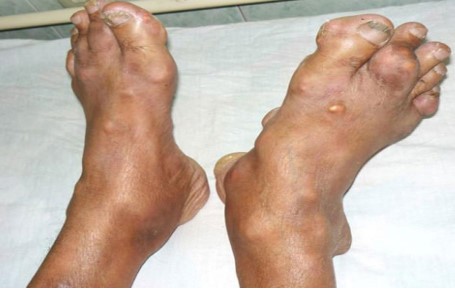 Chân bệnh nhân mắc bệnh gout. Ảnh: BSCC.