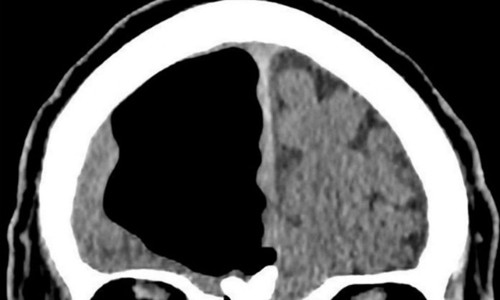 Hình ảnh chụp CT não của cụ ông cho thấy có lỗ hổng trống không. Ảnh: BMJ.