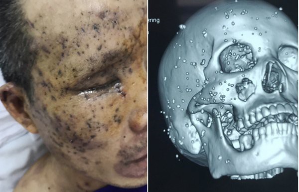 Hơn 100 dị vật nhỏ găm vào vùng mặt, sọ, hốc mắt và xoang hàm bên phải của bệnh nhân (Ảnh thật và ảnh sọ não dựng hình 3D)