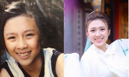 Khánh Linh trước và sau khi niềng răng.