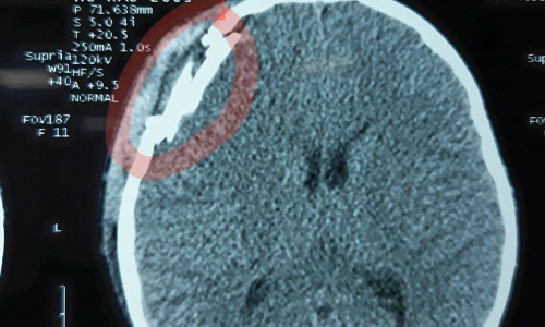 Hình ảnh chụp CT cho thấy trẻ bị vỡ xương sọ.