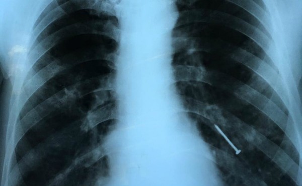 Hình ảnh X-quang cây đinh nằm ở phế quản bệnh nhân. Ảnh: V.T.