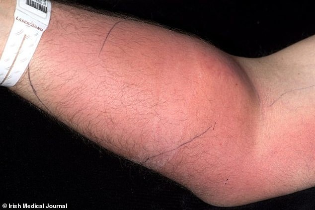 Cánh tay người đàn ông sưng đỏ vì tiêm tinh trùng trong 18 tháng